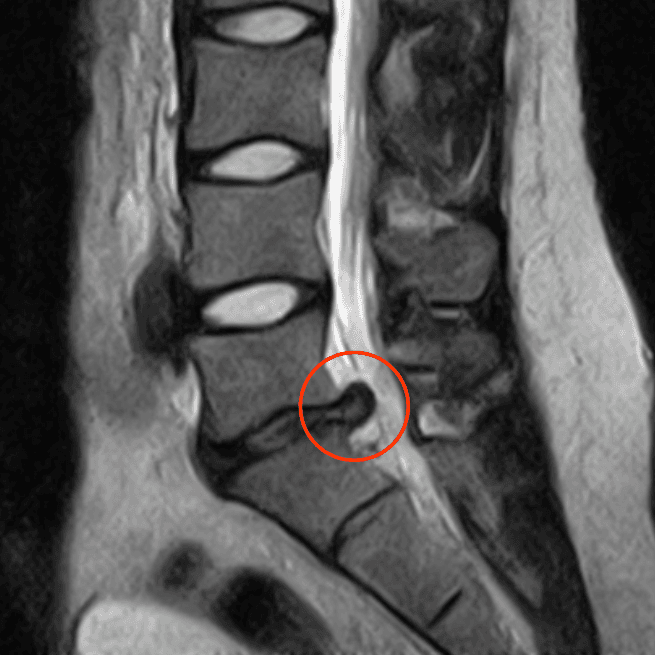 Lombalgie et cervicalgie